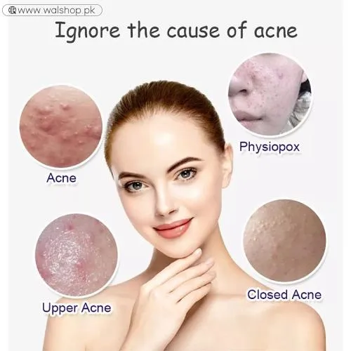 Aichun Beauty Anti Acne Whitening Facial Serum