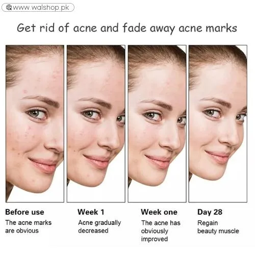 Aichun Beauty Anti Acne Whitening Facial Serum