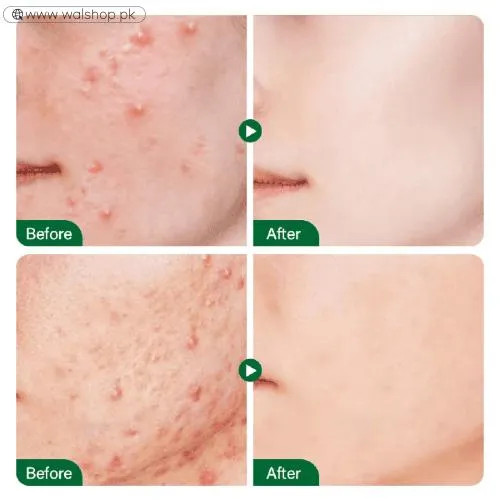 Fort Salicylic Acid Serum